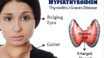 benh-cuong-giap-hyperthyroidism