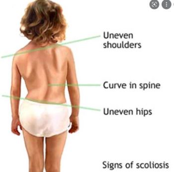 veo-cot-song-scoliosis